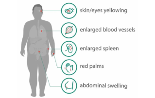 STE: Mindray Ultrasound Technology Unveils the Silent Killer