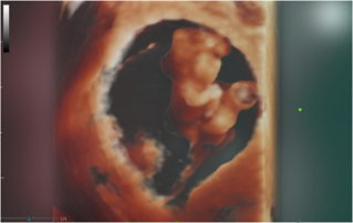 Ultrasound Journal 30 - Fetal Body Stalk Anomaly Diagnosis