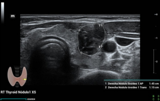 Ultrasound Journal 32 - Multiparametric Ultrasound for the Characterization of Thyroid Nodule: A Case Report