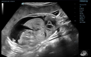 Ultrasound Journal 31 - Ultrasound Diagnosis of Hb Bart's hydrops fetalis