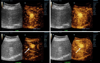 More Precise Diagnoses with HiFR CEUS