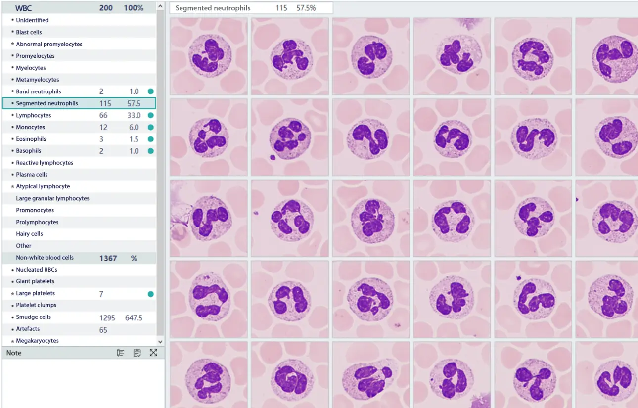 chronic-lymphocytic-leukemia-case-study-fig2