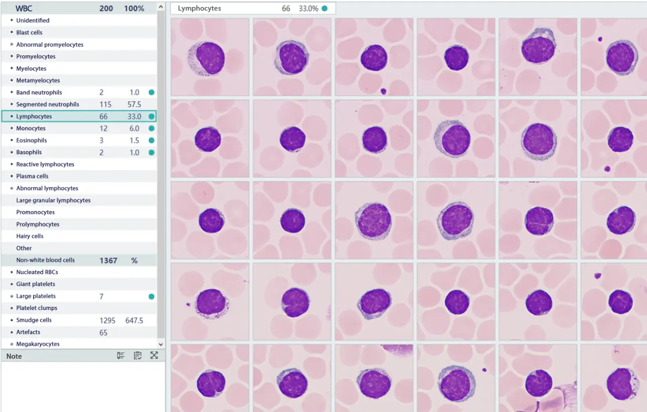 chronic-lymphocytic-leukemia-case-study-fig3